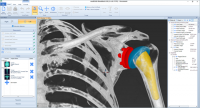PHẪU THUẬT CHỈNH HÌNH KHỚP VAI  VỚI PHẦN MÊM mediCAD® Shoulder 3D (Phần 2)