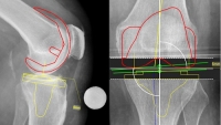 CHỨC NĂNG CƠ BẢN CỦA PHẦN MỀM MEDICAD KNEE 2D -PHẪU THUẬT KHỚP GỐI