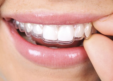 Niềng răng có đau không 